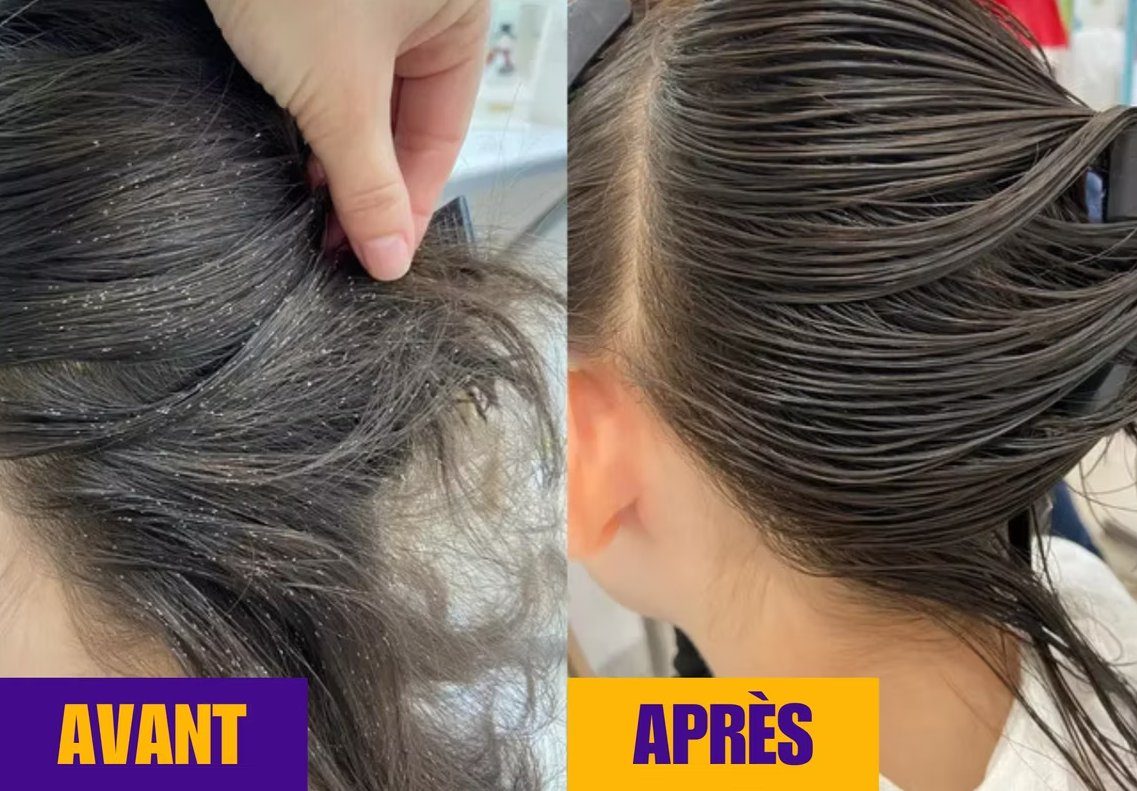 Avant / après un traitement anti-poux à l'Institut Papou : chevelure infestée puis totalement nettoyée